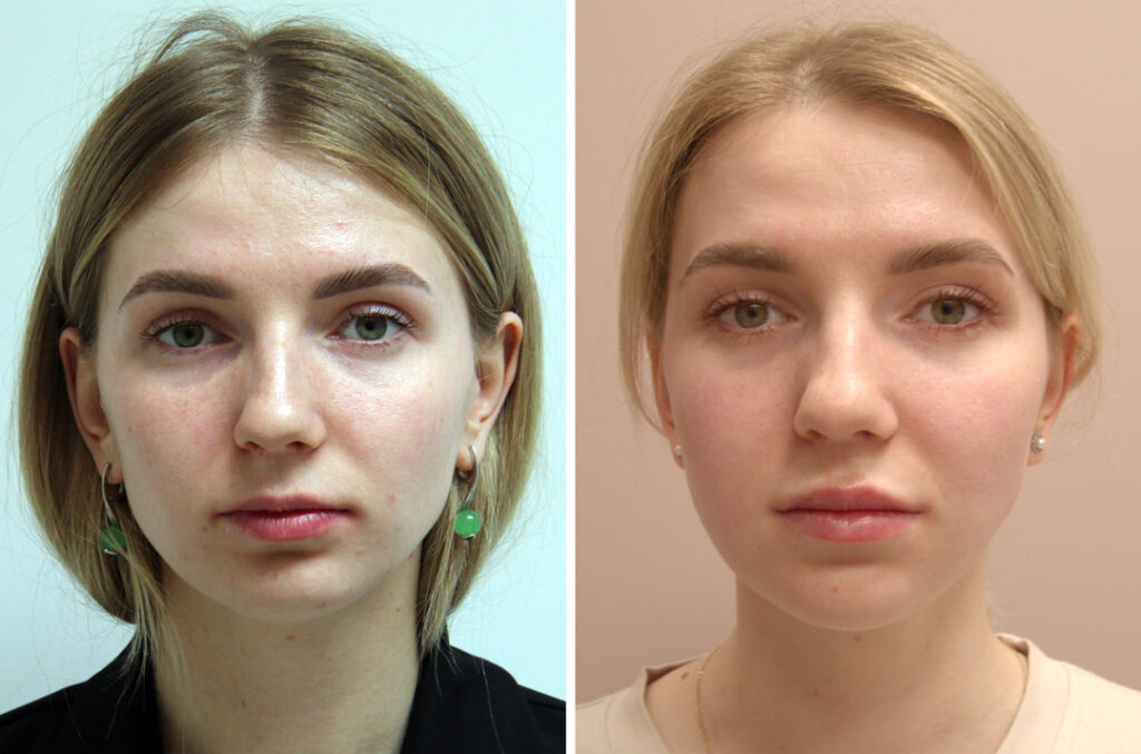 Фото до и после челюстно-лицевых операций