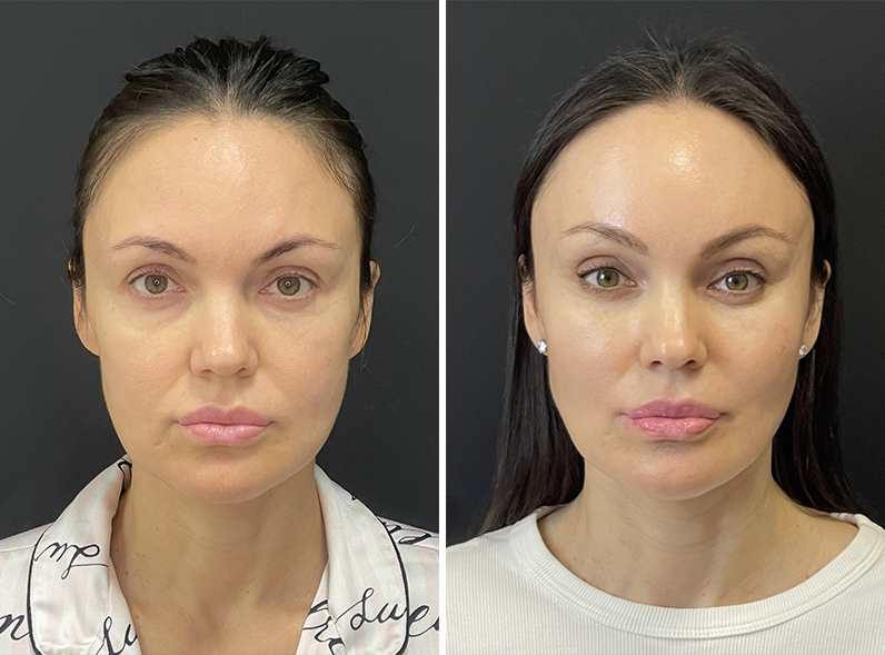 Процедуры после пластики. Сотрудничество хирурга и косметолога