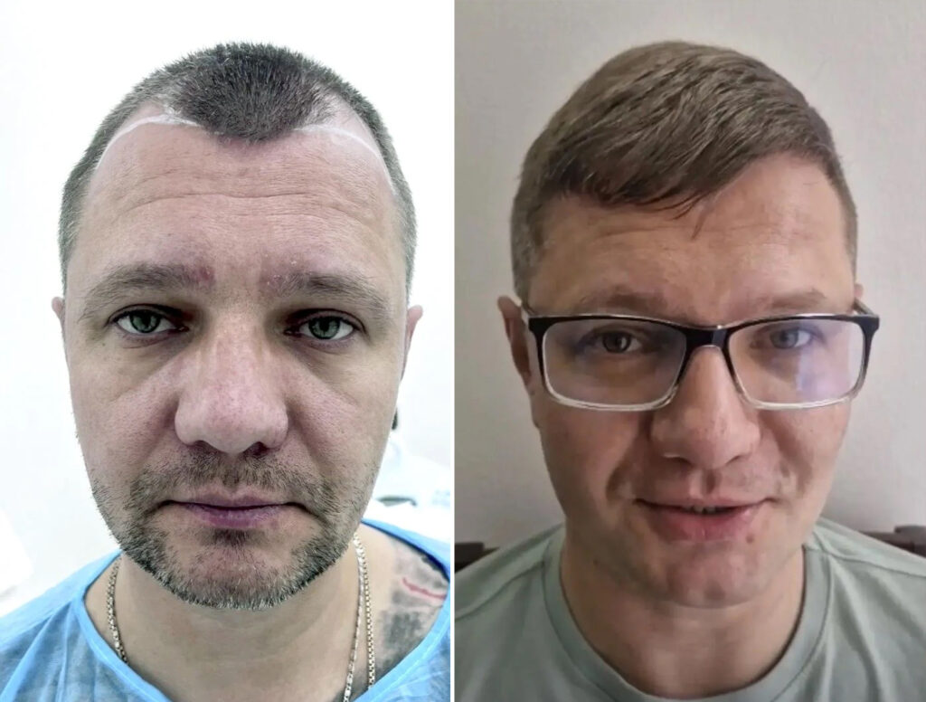 Операция по пересадке волос