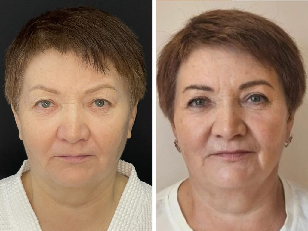 Блефаропластика, до и после