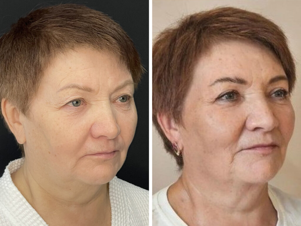 Блефаропластика, до и после