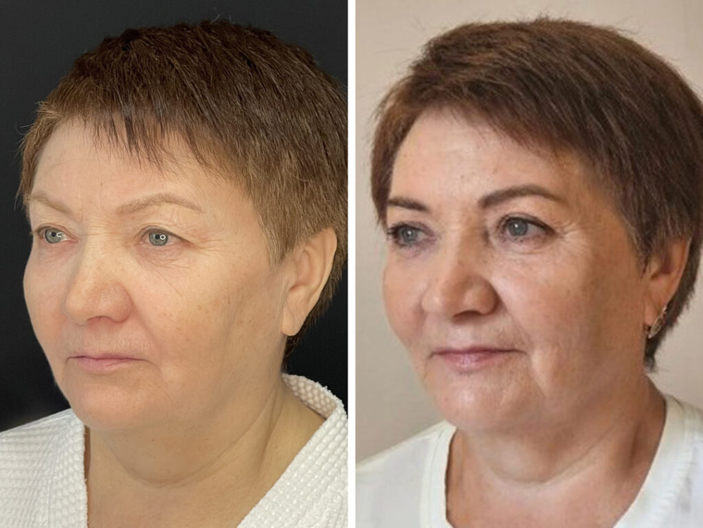 Блефаропластика, до и после