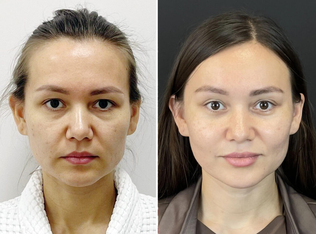 Эндоскопическое омоложение лица, до и после