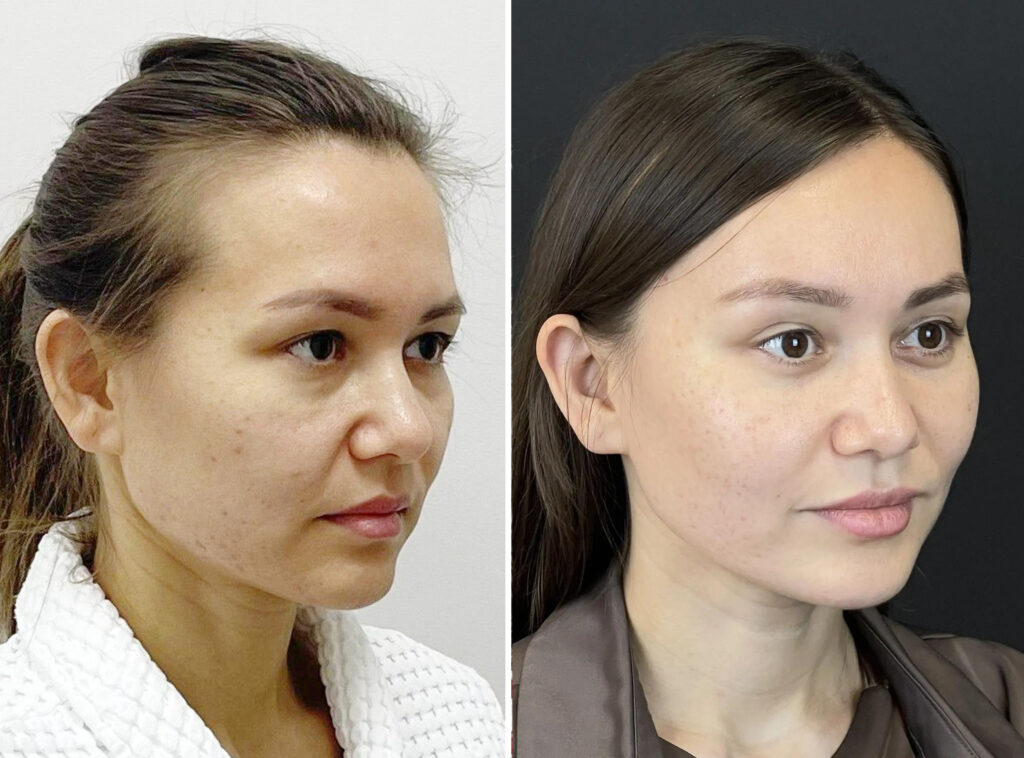 Эндоскопическое омоложение лица, до и после