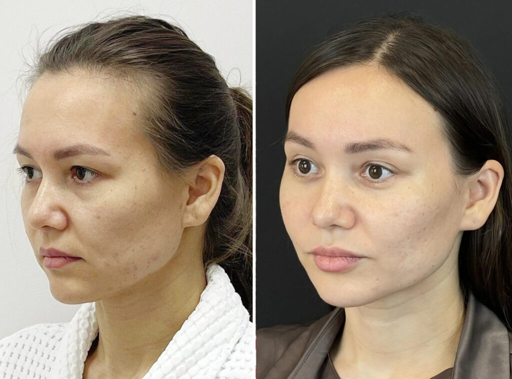 Эндоскопическое омоложение лица, до и после