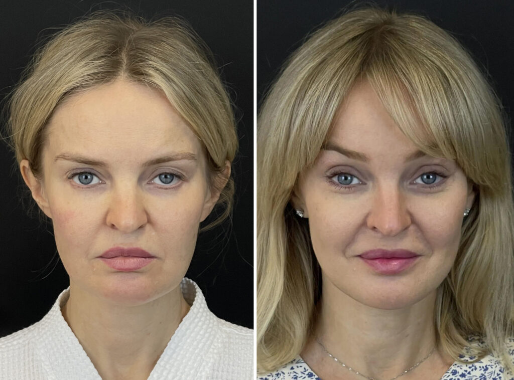 Эндоскопическое омоложение лица, до и после