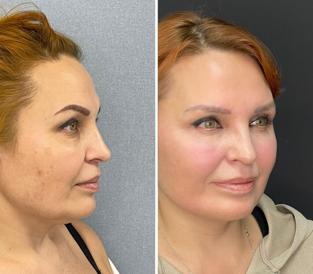 Лифтинг нижней трети лица и шеи (SMAS lifting), до и после